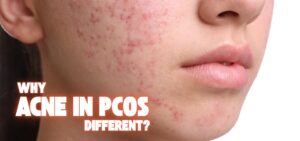Read more about the article Why is Acne in PCOS different