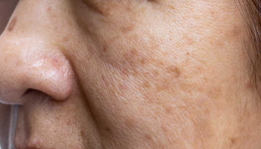 Melasma Skin Treatment | Effective Solutions for Clear Skin Melasma Skin Treatment | Effective Solutions for Clear Skin